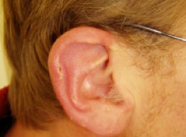 Ohr mit Psoriasis